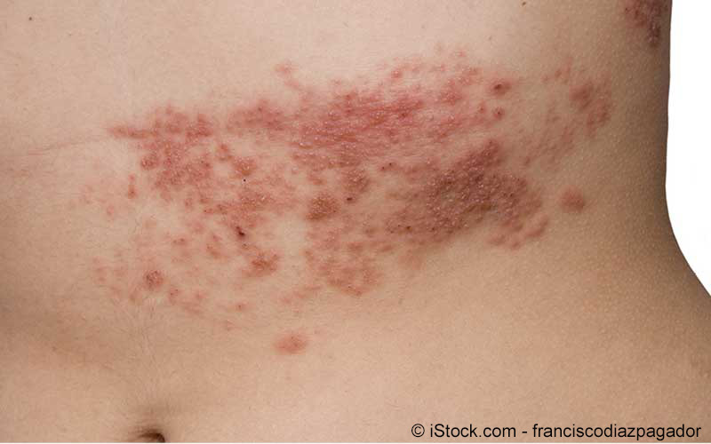 Nachwirkungen krätze Krätze (Scabies)