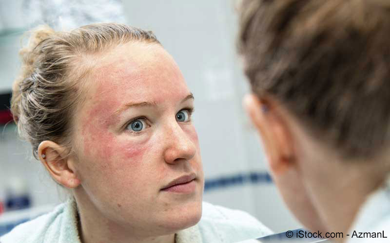 Rosacea Ursachen Symptome Behandlung Meine Gesundheit