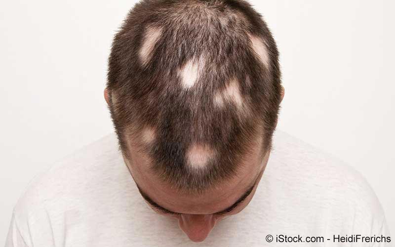 Männer haarausfall haare kurze Was Gefällt