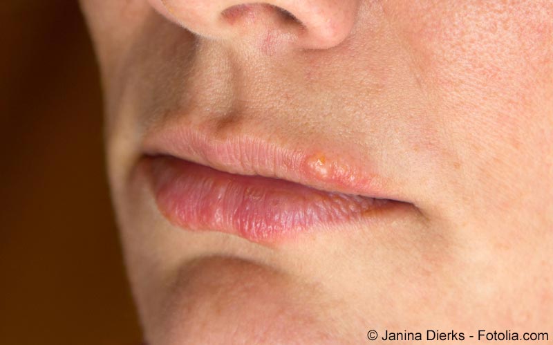 Schwillt an lippe allergie Lebensmittelallergie: Symptome,