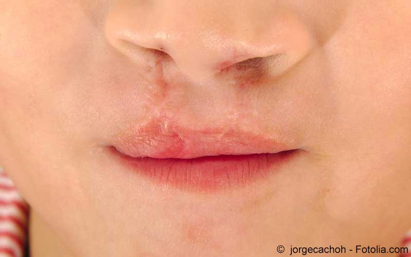 Lippenherpes Ursachen Symptome Behandlung Meine Gesundheit