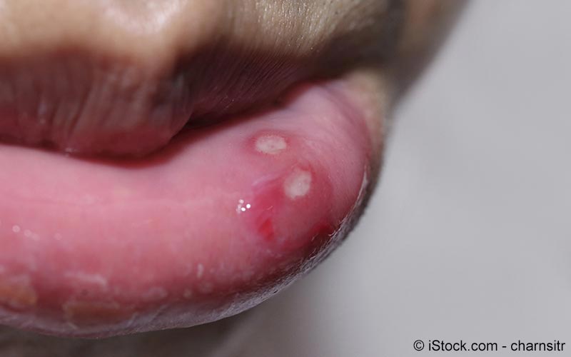 Lippenherpes Ursachen Symptome Behandlung Meine Gesundheit