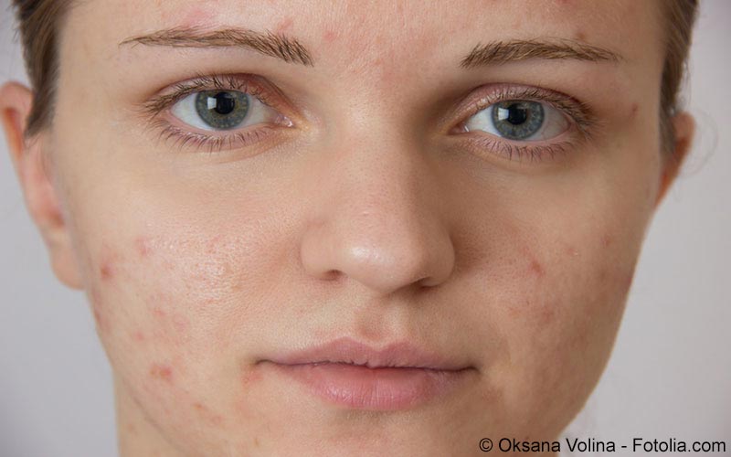 Rosacea Ursachen Symptome Behandlung Meine Gesundheit