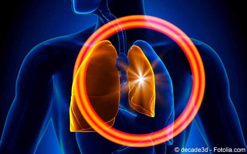 Pneumothorax Pneumothorax