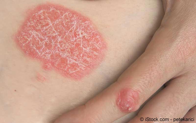 psoriasis behandlung